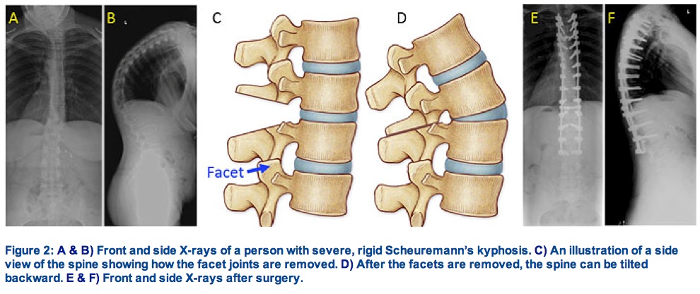 Kyphosis | Prof. Youssry Elhawary